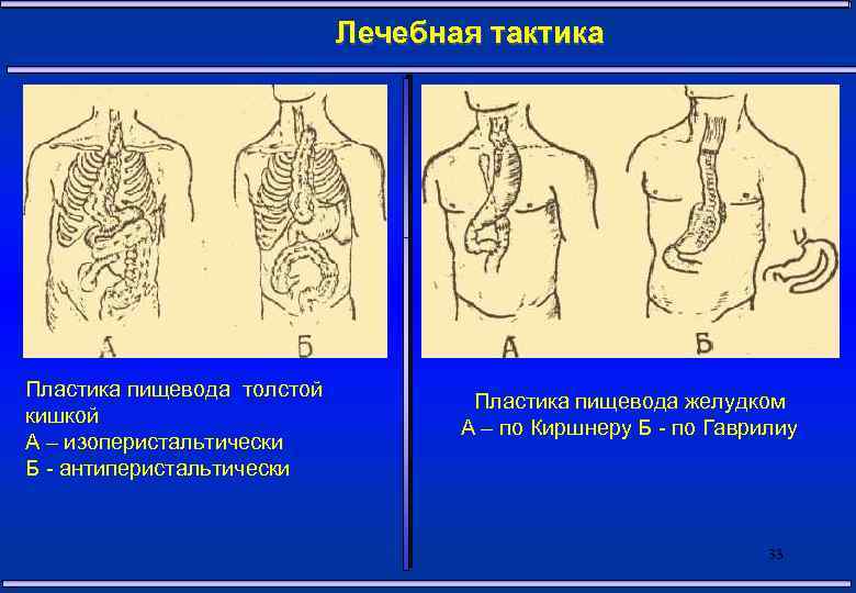Лечебная тактика Пластика пищевода толстой кишкой А – изоперистальтически Б - антиперистальтически Пластика пищевода