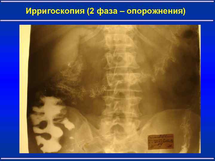 Ирригоскопия (2 фаза – опорожнения) 10 