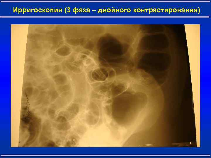 Ирригоскопия (3 фаза – двойного контрастирования) 11 
