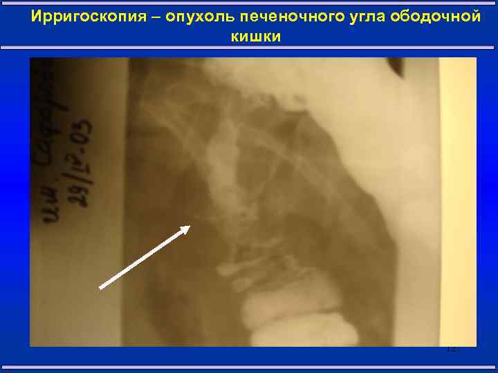 Ирригоскопия – опухоль печеночного угла ободочной кишки 12 