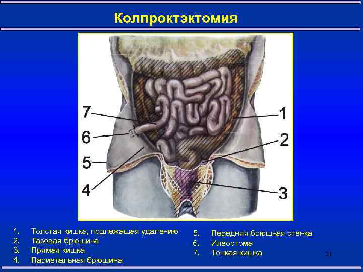 Колпроктэктомия 1. 2. 3. 4. Толстая кишка, подлежащая удалению Тазовая брюшина Прямая кишка Париетальная