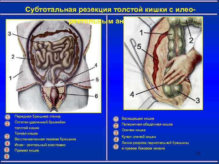 Субтотальная резекция толстой кишки с илеоректальным анастомозом 1 Передняя брюшная стенка 2 Остатки удаленной