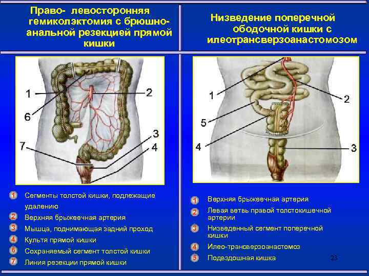 Право- левосторонняя гемиколэктомия с брюшноанальной резекцией прямой кишки 1 Сегменты толстой кишки, подлежащие удалению