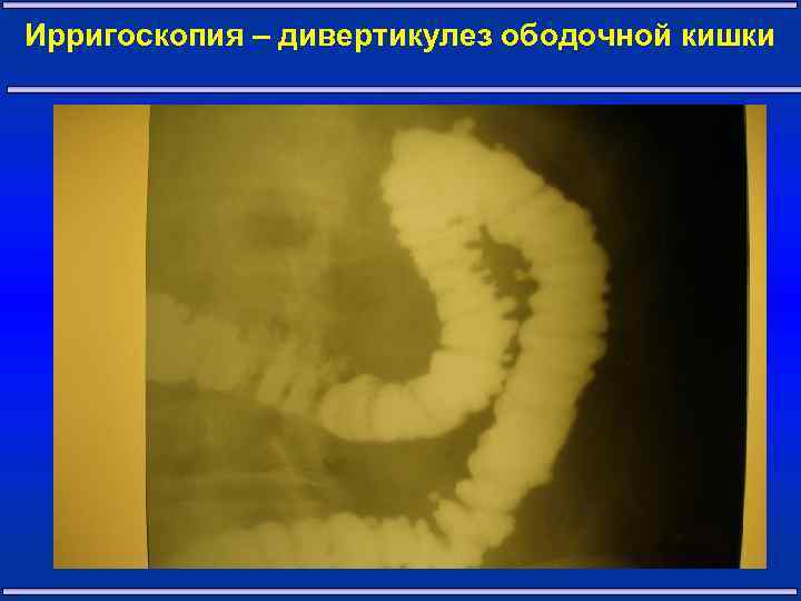 Ирригоскопия – дивертикулез ободочной кишки 34 