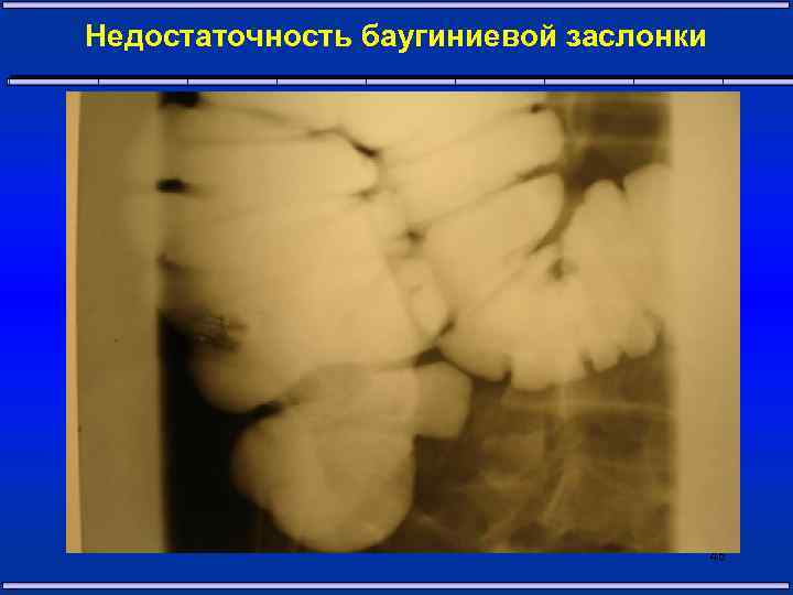 Недостаточность баугиниевой заслонки 46 