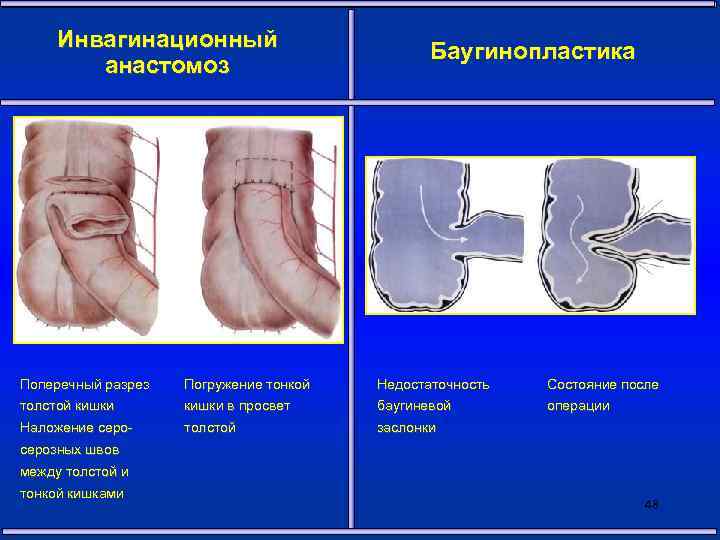 Инвагинационный анастомоз Баугинопластика Поперечный разрез Погружение тонкой Недостаточность Состояние после толстой кишки в просвет
