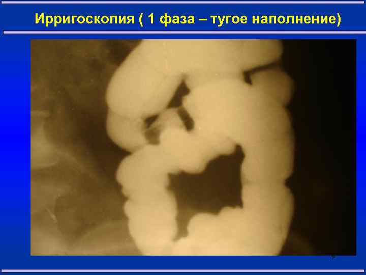 Ирригоскопия ( 1 фаза – тугое наполнение) 9 