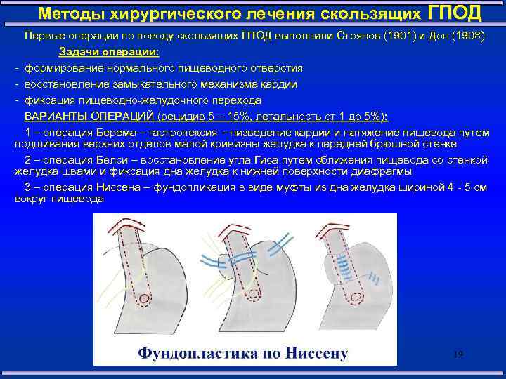Методы хирургического лечения скользящих ГПОД Первые операции по поводу скользящих ГПОД выполнили Стоянов (1901)