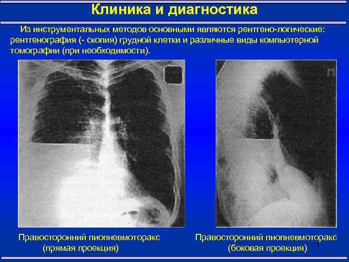 Клиника и диагностика Из инструментальных методов основными являются рентгено-логические: рентгенография (- скопия) грудной клетки