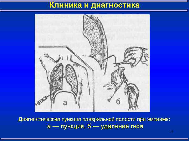 Экссудативный плеврит пункция