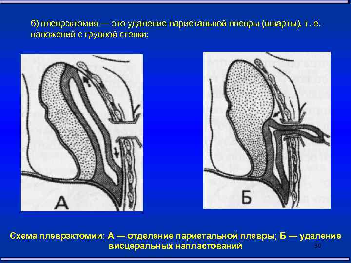 Плеврэктомия