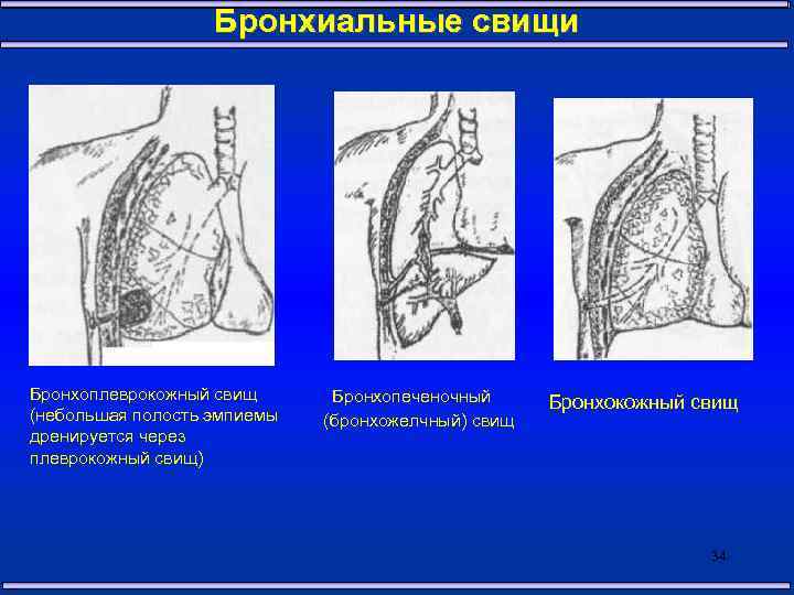 Свищи хирургия презентация