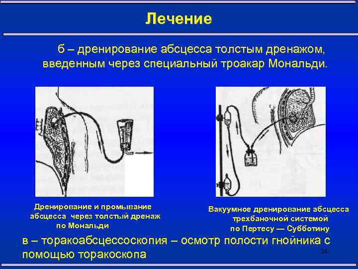 Дренирование. Трансторакальное дренирование по Сельдингеру. Дренирование аппендикулярного абсцесса. Дренирование по Сельдингеру методика. Дренирование при абсцессе легкого.