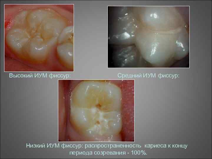 Высокий ИУМ фиссур: Средний ИУМ фиссур: Низкий ИУМ фиссур: распространенность кариеса к концу периода