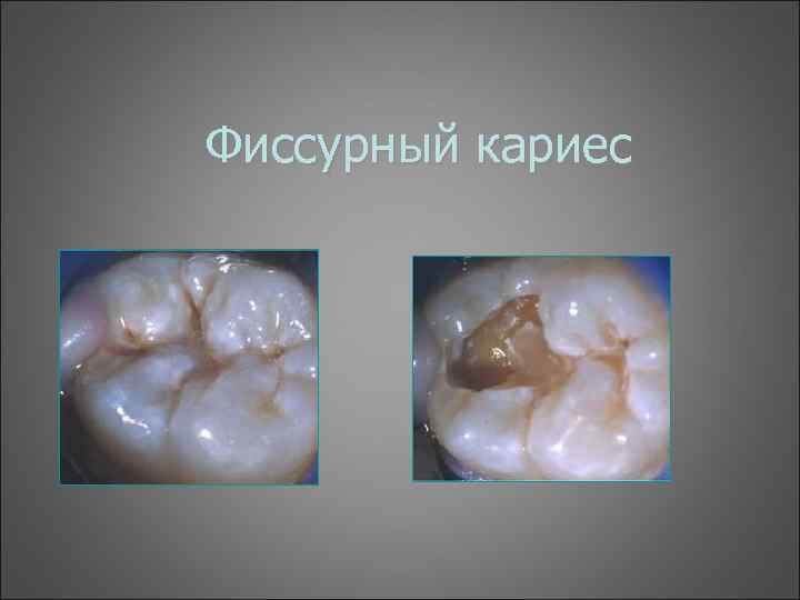 Фиссурный кариес 