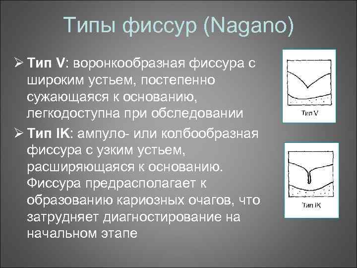 Типы фиссур (Nagano) Ø Тип V: воронкообразная фиссура с широким устьем, постепенно сужающаяся к