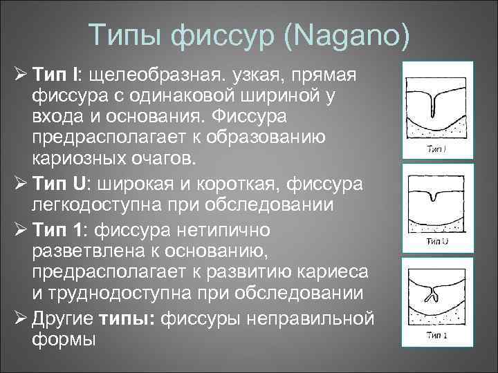 Типы фиссур (Nagano) Ø Тип I: щелеобразная. узкая, прямая фиссура с одинаковой шириной у