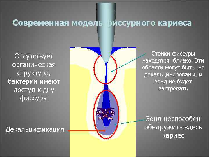 Современная модель фиссурного кариеса Отсутствует органическая структура, бактерии имеют доступ к дну фиссуры Декальцификация