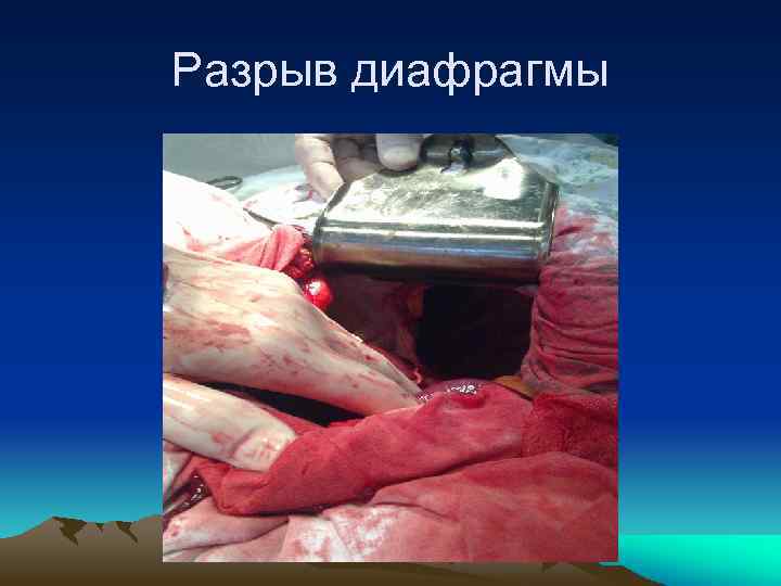Разрыв диафрагмы 