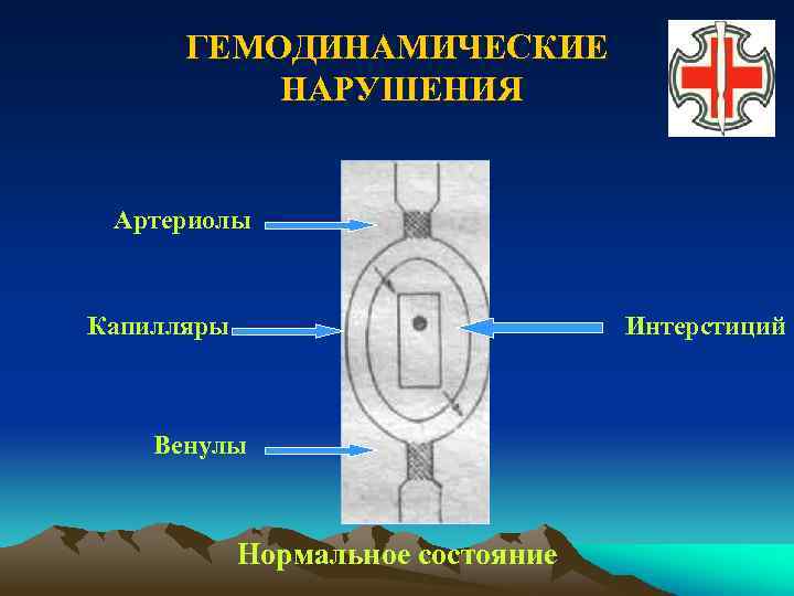 ГЕМОДИНАМИЧЕСКИЕ НАРУШЕНИЯ Артериолы Капилляры Интерстиций Венулы Нормальное состояние 