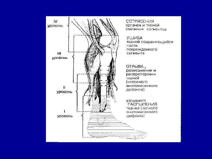 • ОСНОВНОЙ ПРИНЦИП ЛЕЧЕНИЯ ОГНЕСТРЕЛЬНЫХ РАН • Двухэтапный принцип лечения • • ОСНОВНОЙ ПРИНЦИП ЛЕЧЕНИЯ ОГНЕСТРЕЛЬНЫХ РАН • Двухэтапный принцип лечения •