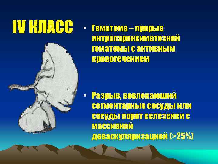 IV КЛАСС • Гематома – прорыв интрапаренхиматозной гематомы с активным кровотечением • Разрыв, вовлекаюший