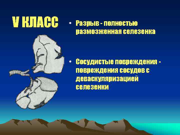 V КЛАСС • Разрыв - полностью размозженная селезенка • Сосудистые повреждения сосудов с деваскуляризацией