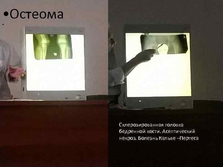  • Остеома • Склерозированная головка бедренной кости. Асептический некроз. Болезнь Кальве –Пертеса 