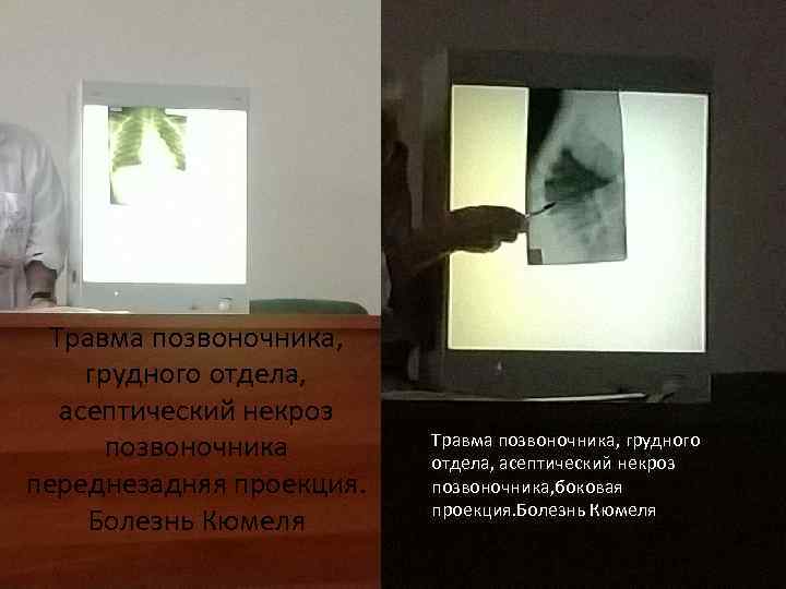 Травма позвоночника, грудного отдела, асептический некроз позвоночника переднезадняя проекция. Болезнь Кюмеля Травма позвоночника, грудного