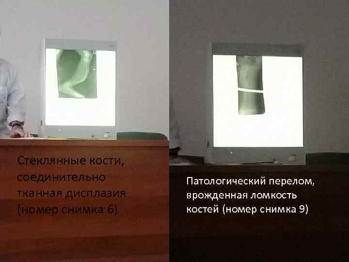 Стеклянные кости, соединительно тканная дисплазия (номер снимка 6) Патологический перелом, врожденная ломкость костей (номер