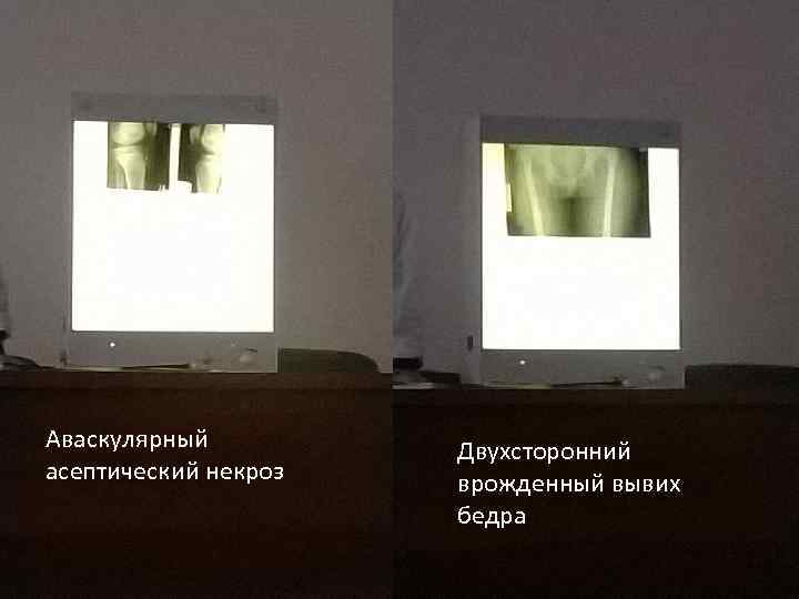 Аваскулярный асептический некроз Двухсторонний врожденный вывих бедра 