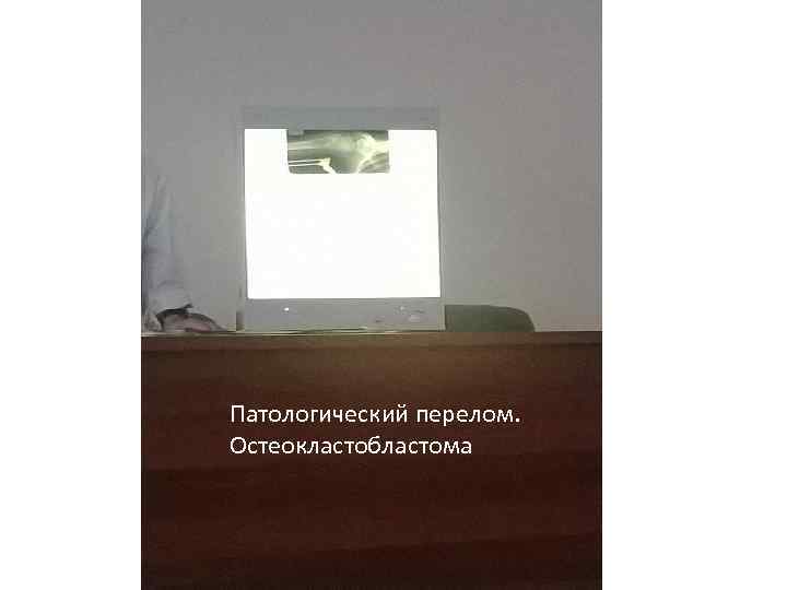 Патологический перелом. Остеокластобластома 