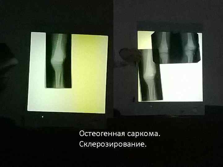 Остеогенная саркома. Склерозирование. 