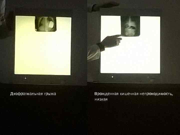 Диафрагмальная грыжа Врожденная кишечная непроходимость, низкая 