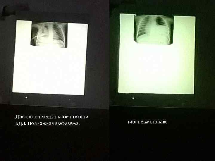 Дренаж в плевральной полости. БДЛ. Подкожная эмфизема. пиопневмоторакс 