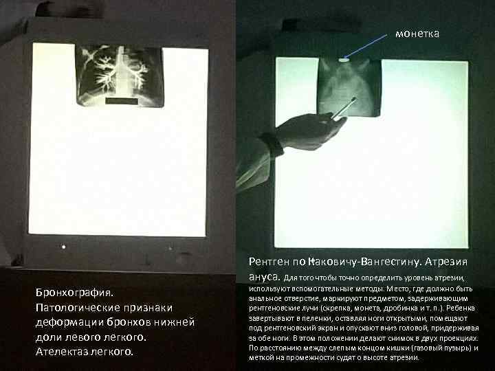 монетка Рентген по Каковичу-Вангестину. Атрезия ануса. Для того чтобы точно определить уровень атрезии, Бронхография.