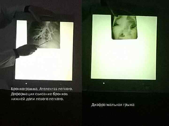 Бронхограмма. Ателектаз легкого. Деформация свисание бронхов нижней доли левого легкого. Диафрагмальная грыжа 
