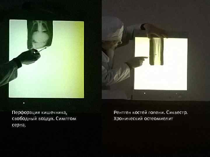 Перфорация кишечника, свободный воздух. Симптом серпа. Рентген костей голени. Сиквестр. Хронический остеомиелит 