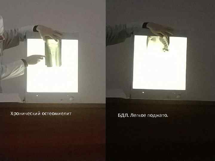 Хронический остеомиелит БДЛ. Легкое поджато. 