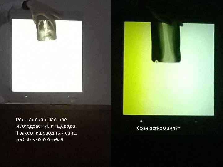 Рентгеноконтрастное исследование пищевода. Трахеопищеводный свищ дистального отдела. Хрон остеомиелит 