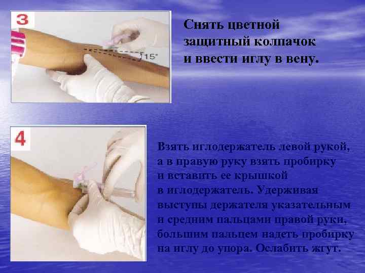 Снять цветной защитный колпачок и ввести иглу в вену. Взять иглодержатель левой рукой, а