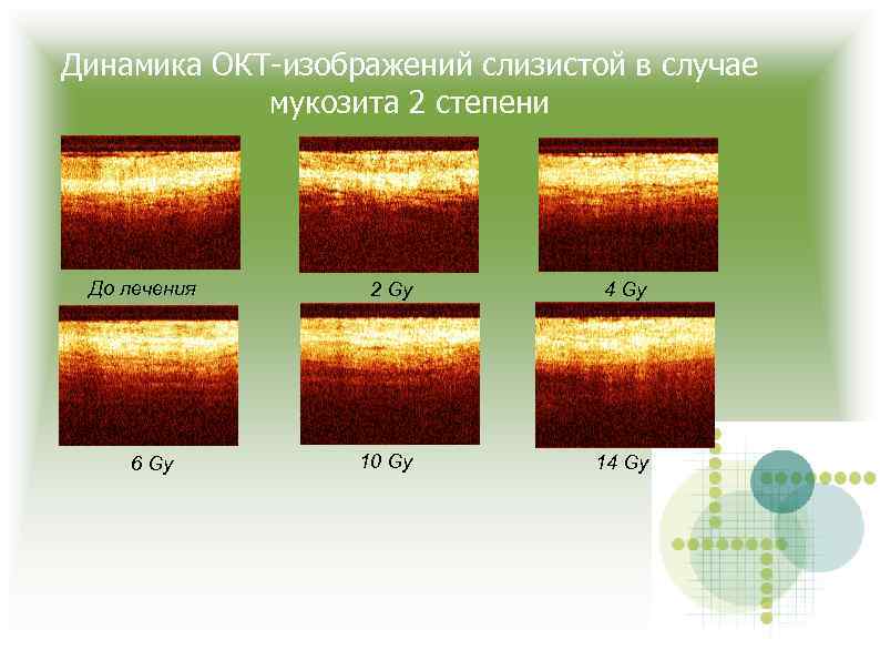 Динамика ОКТ-изображений слизистой в случае мукозита 2 степени До лечения 6 Gy 2 Gy