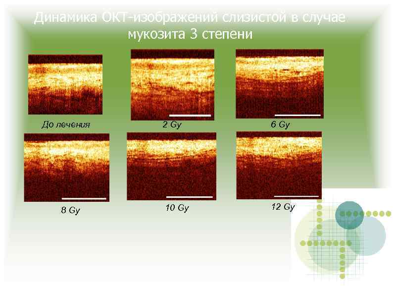 Динамика ОКТ-изображений слизистой в случае мукозита 3 степени До лечения 8 Gy 2 Gy