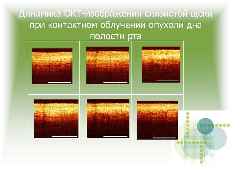 Динамика ОКТ-изображения слизистой щеки при контактном облучении опухоли дна полости рта 