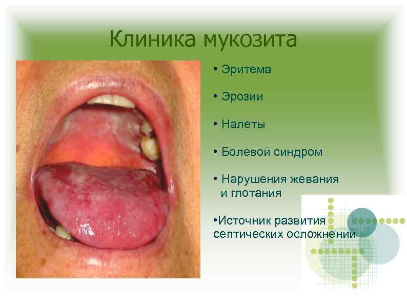 Клиника мукозита • Эритема • Эрозии • Налеты • Болевой синдром • Нарушения жевания