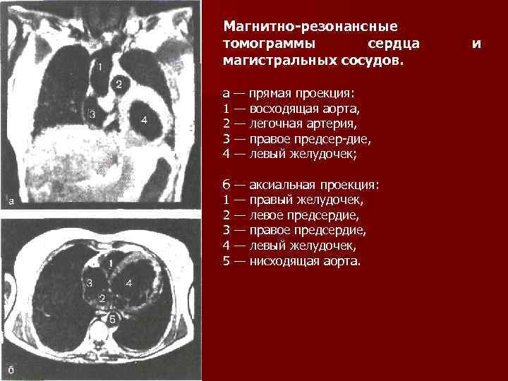 Магнитно-резонансные томограммы сердца магистральных сосудов. а — прямая проекция: 1 — восходящая аорта, 2