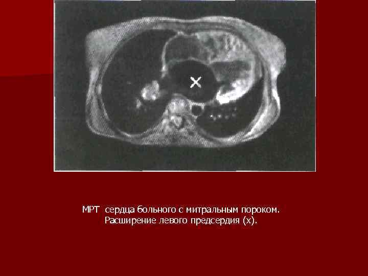 МРТ сердца больного с митральным пороком. Расширение левого предсердия (х). 