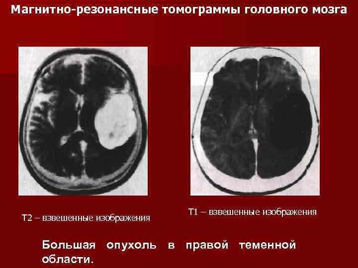 Т1 и т2 взвешенные изображения в мрт