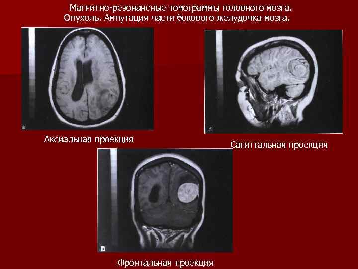 Магнитно резонансные томограммы головного мозга. Опухоль. Ампутация части бокового желудочка мозга. Аксиальная проекция Фронтальная