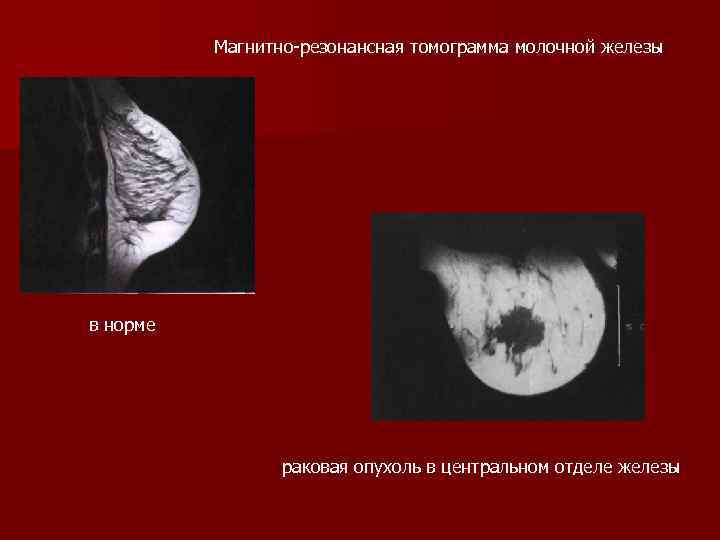 Магнитно резонансная томограмма молочной железы в норме раковая опухоль в центральном отделе железы 